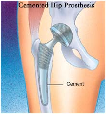 cemented hip