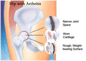 hip with arthritis diagram