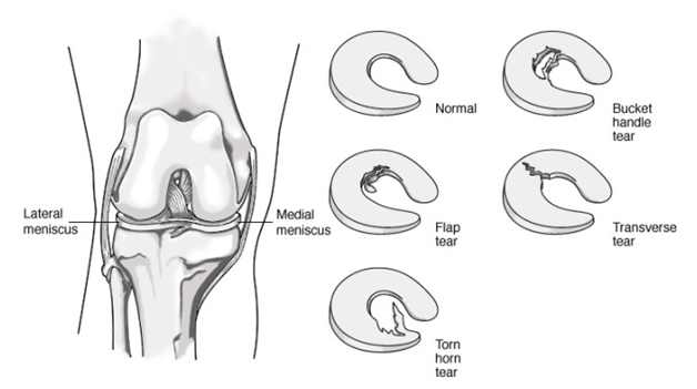 knee implant 3