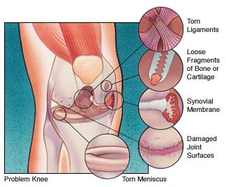 knee problem diagram