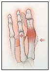 repair tendon