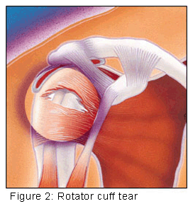 rotator cuff tear2