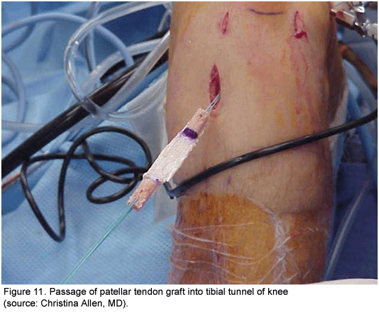 figure 11 passage of patellar tendon