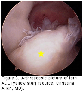 figure 3 torn ACL