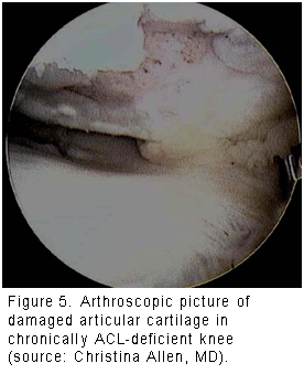 figure 5 damaged ACL