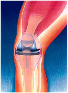 knee replacement diagram 1